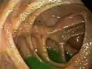 Parasitic Infection - Purely Earth
 Pinworm Eggs In Poop
