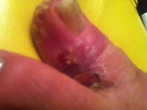 Fungal Toe Infection 1