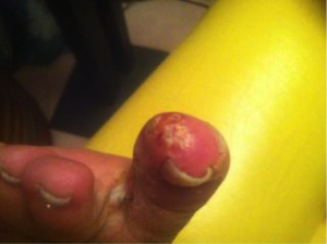Fungal Toe Infection 2
