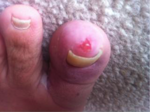 Fungal Toe Infection 3