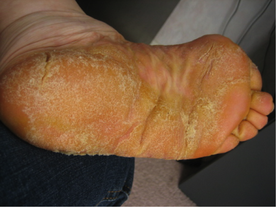 Plantar keratoderma Idea